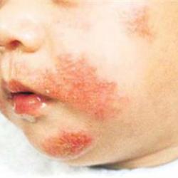 Mối nguy hiểm từ khăn ướt kém chất lượng và không rõ nguồn gốc
